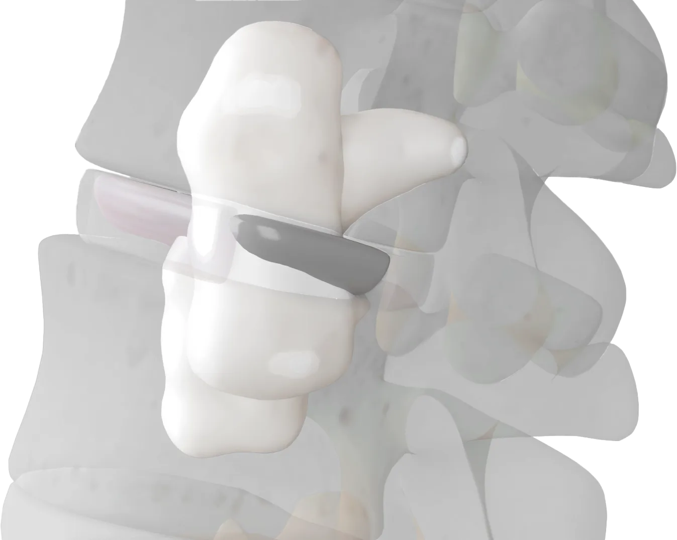 3D rendering of a lumbar interbody spacer placed between two vertebrae